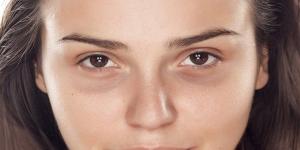علاج
      الهالات
      السوداء
      حول
      العينين
      بالوصفات
      الطبيعية