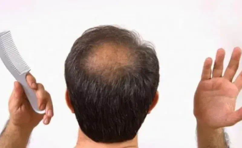 اكتشاف مذهل.. علاج طبيعي ينهي تساقط الشعر ويعيده كما كان في وقت قياسي