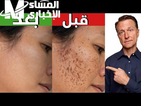 كل البقع راحت في ثانية.. وصفات للبشرة توحيد مضمون