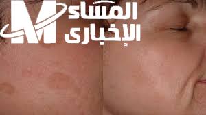 تصبغات الوجه