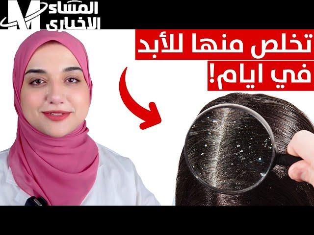 من غير شعرك ما يجف أو يتلف.. طرق وصفات طبيعية للتخلص من قشرة الشعر