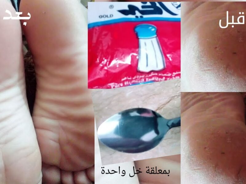 لو بتعانى من تشققات القدمين ….جبتلك الحل السريع كله في معلقتين خل وبس