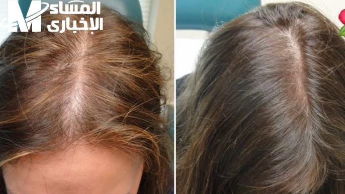 تكثيف الشعر وملء الفراغات
