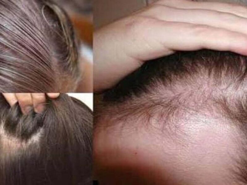 الفراغات اتقفلت في ثانية .. تكثيف الشعر وملء الفراغات هيرجع شعرك زي الأول