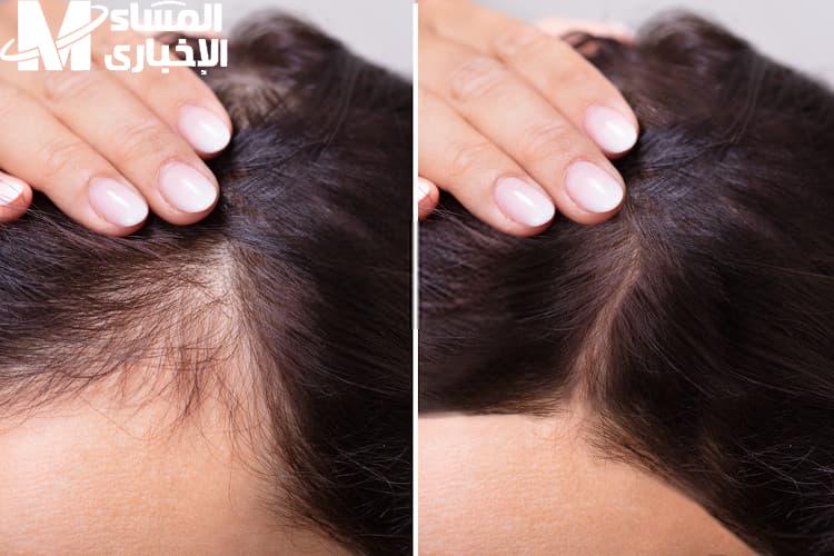 تكثيف الشعر وملء الفراغات