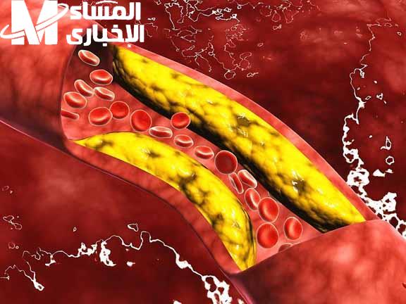 خذ بالك منها كويس.. علامة تظهر في فروة الرأس تشير إلى ارتفاع نسبة الكوليسترول