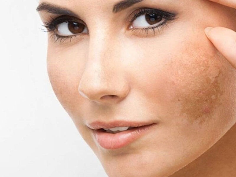 التصبغات اختفت بالراحة.. علاج تصبغات الوجه طبيعياً بأسلوب آمن