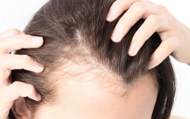 بهذه الطرق فقط.. ملئ الشعر وتكثيفه وزيادة الشعر في كافة الفراغات جربيها في البيت