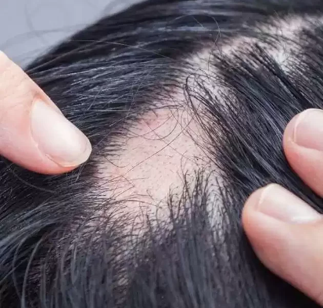 رجّع شعرك في أسبوع.. وقف تساقط الشعر هيرجع شعرك تاني حل مضمون