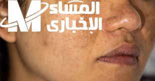 ماسك القمر.. ماسك لتوحيد لون البشرة وتبييض الجلد