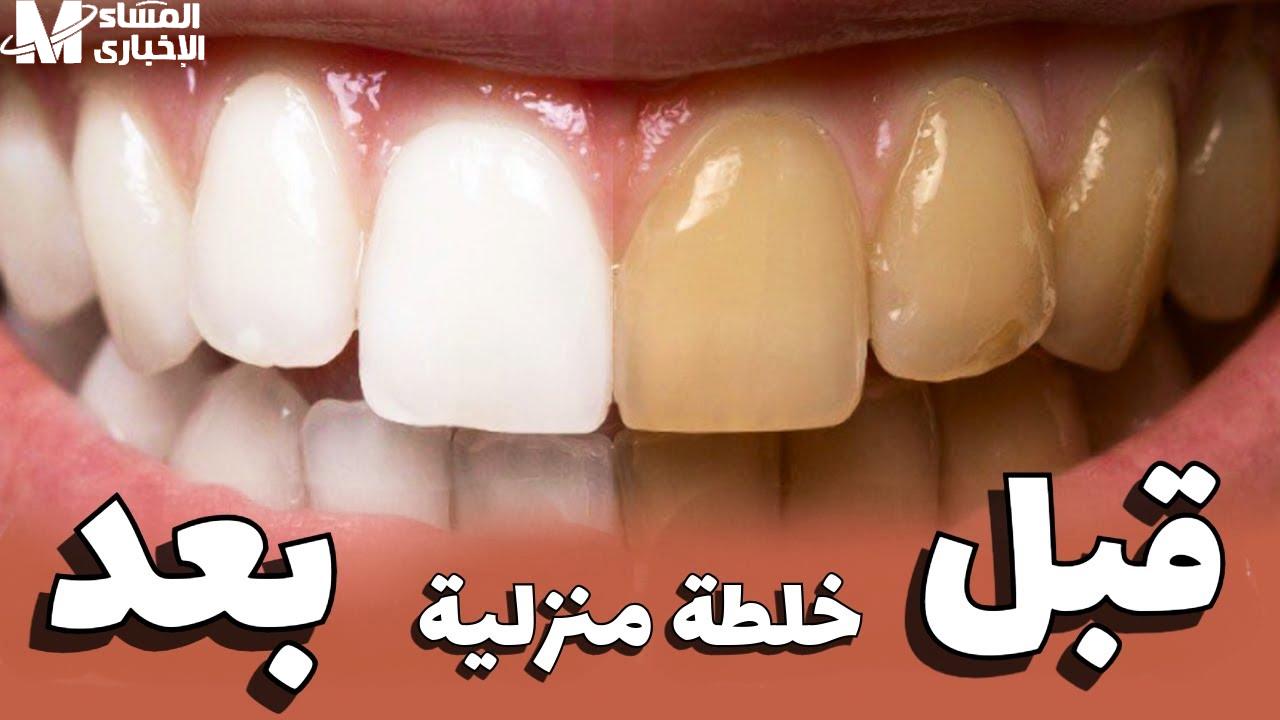 تبييض الأسنان